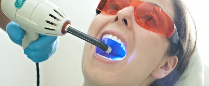 Things You Should Know about Teeth Whitening Procedures