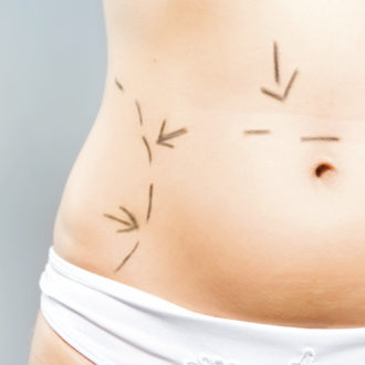 How To Prepare Yourself For Liposuction Surgery?