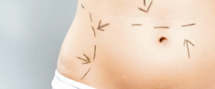 How To Prepare Yourself For Liposuction Surgery?