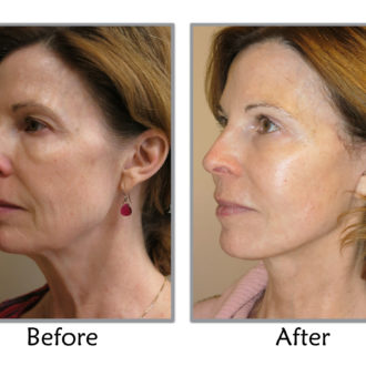 What Do You Know About Face Lift?