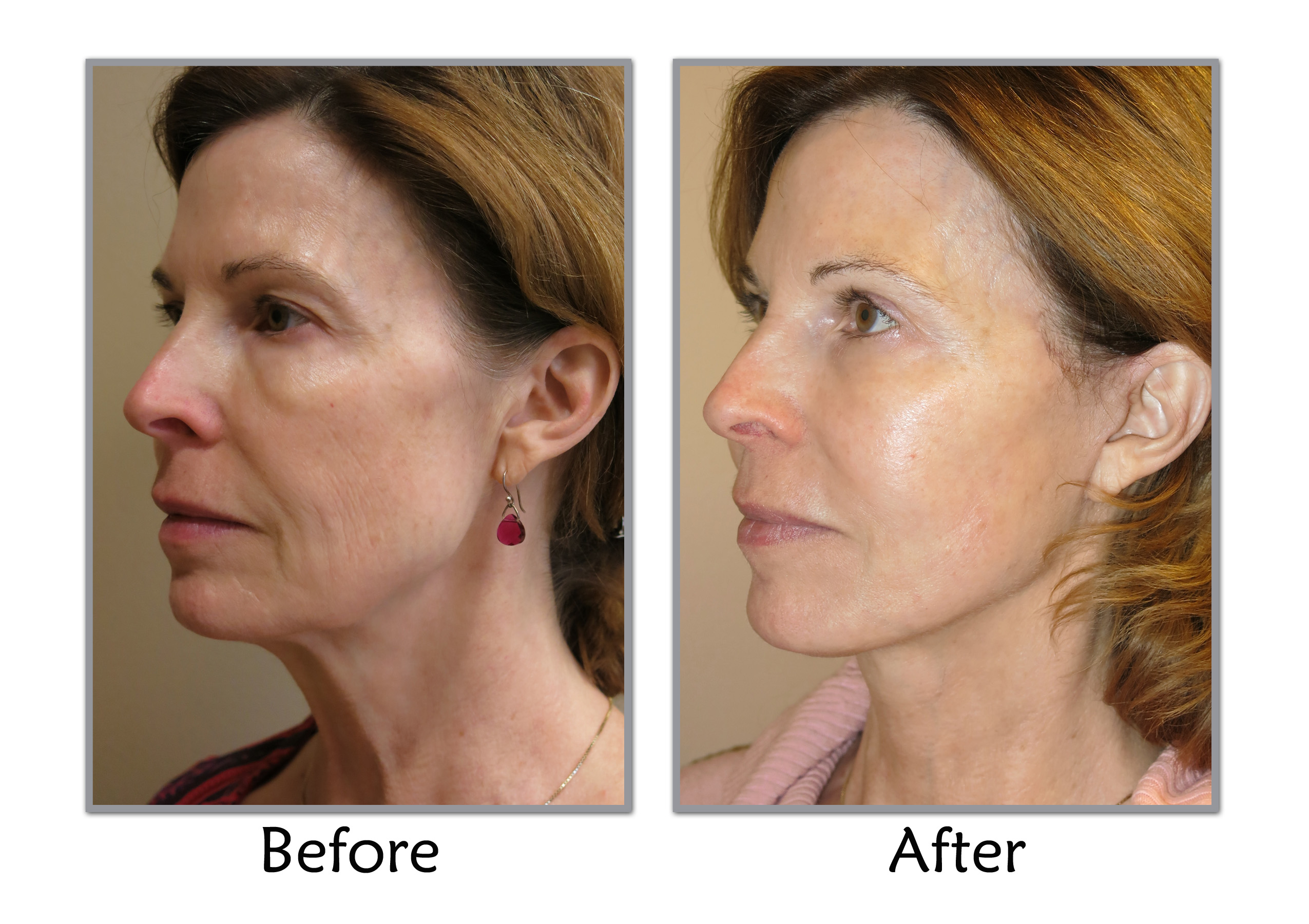 experience-the-cutting-edge-micro-mini-facelift-procedure-by-dr-godin