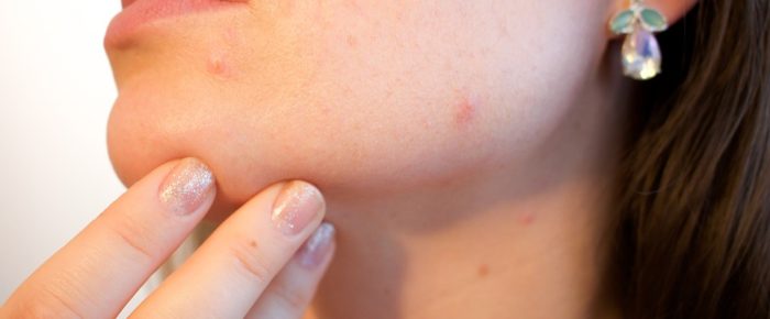 5 Simple Hacks to Deal With Pimple Quickly
