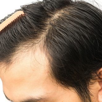 Why It Is Suggested Not too Anxious during Hair Transplant Surgery