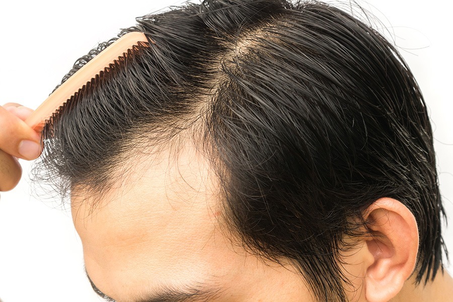 Hair Transplant