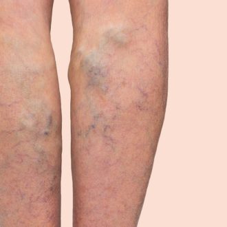 Why Varicose Veins Are More Than Just a Cosmetic Issue