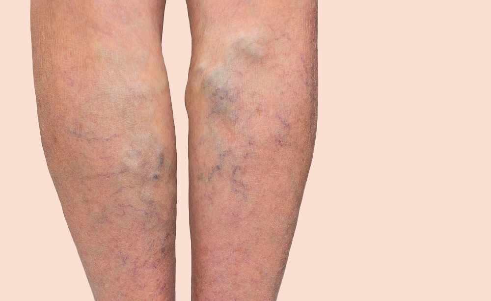 Varicose Veins