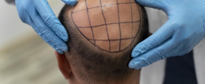 How Hair Transplant Surgery in Delhi Can Make You Happy