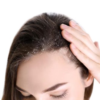 Lice Eggs vs. Dandruff: What’s Causing Your Scalp Issues?