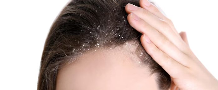 Lice Eggs vs. Dandruff: What’s Causing Your Scalp Issues?